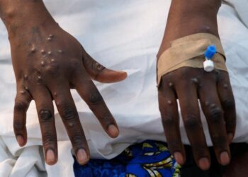 RDC : vers la fin de l’épidémie de Mpox, le gouvernement prêt à officialiser
