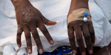 RDC : vers la fin de l’épidémie de Mpox, le gouvernement prêt à officialiser